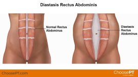 Diastasis Rectus Abdominis_ChoosePT_frame.jpg