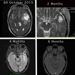 MRI Comparison on a person sufering with GBM4 before and after Humanofort..jpg