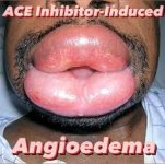 angioedema.jpg