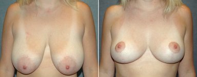 breast-reduction-01a2.jpg