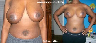 stephanie-breast-reduction.jpg