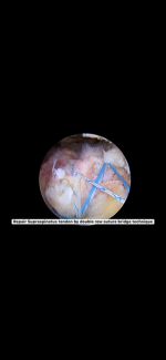 Rotator cuff repair.PNG