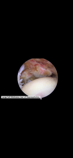 Rotator cuff_off bone.docx.PNG