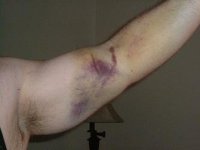 bicep bruise.jpg