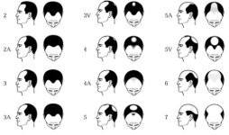 Norwood Scale.jpg