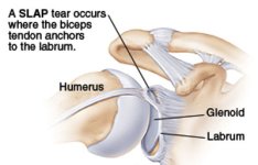 labrum-tear2.jpg